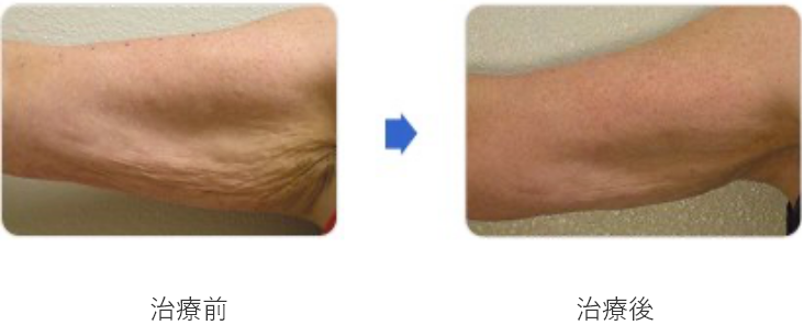 サーマクールFLX/CPT｜美容皮膚科シロノクリニック｜恵比寿院(東京都