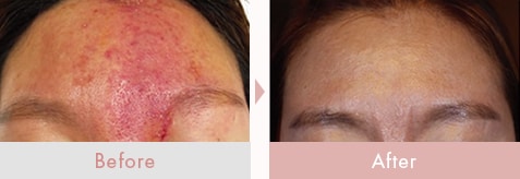 エレクトロポレーション（イオン導入）｜美容皮膚科なら湘南美容