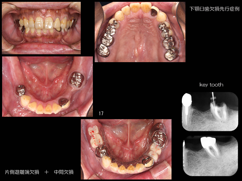 歯牙模型 補綴 歯科 下顎遊離端欠損 奥歯を失う…片側性遊離端欠損