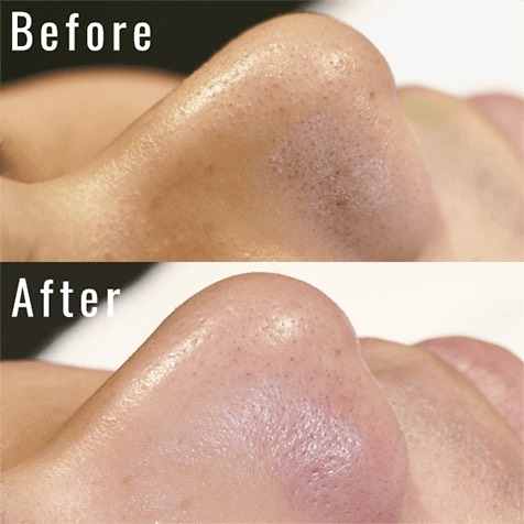 新メニュー セルフフェイシャル（毛穴洗浄）が人気！ | SELFMADE 日進