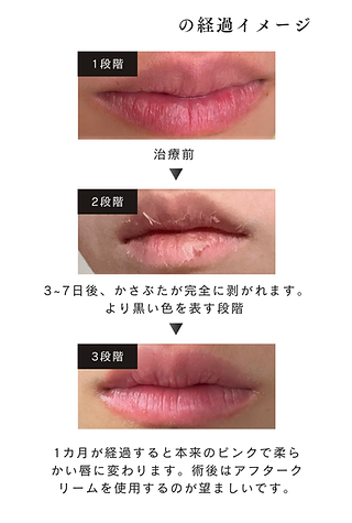 Roma Pink LEDセット Roma Pink LEDセット 導入数NO.1】ローマピンク